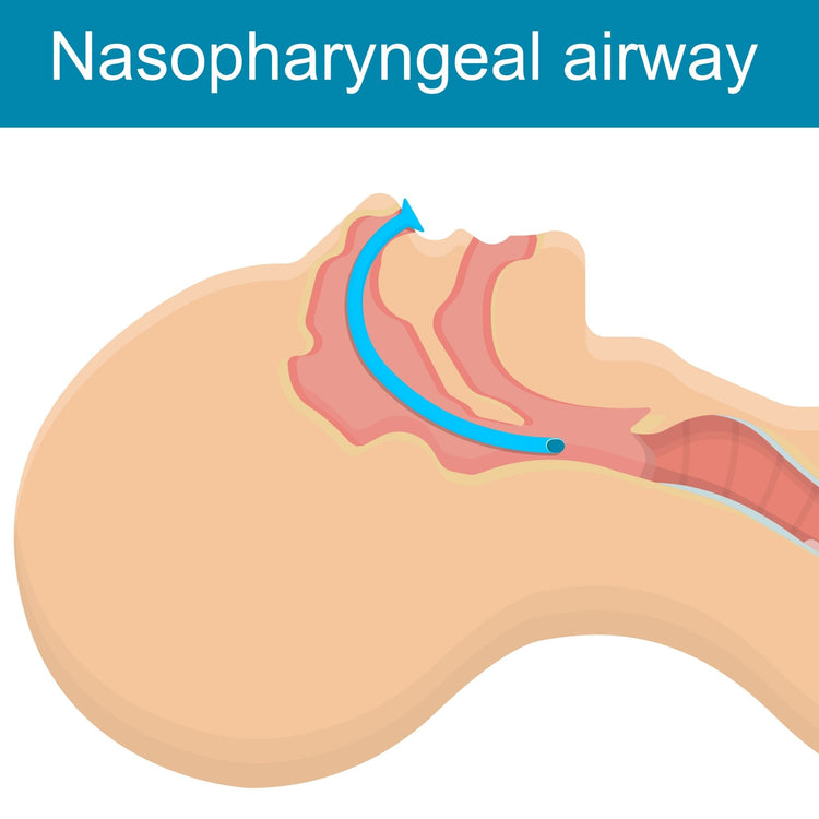 A medical illustration showing a cross-section of the human head and throat. It visualizes the correct placement of the "Nasopharyngeal airway," showing the blue tube inserted through the nose (nasopharynx) to maintain an open air passage behind the tongue.