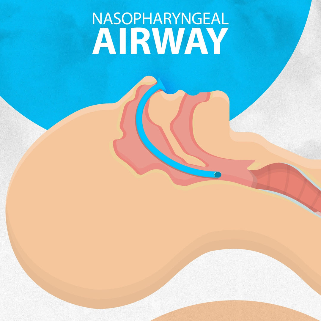 A medical illustration showing a cross-section of a human head in profile. A blue nasopharyngeal airway is shown correctly inserted through the nostril, extending down the back of the throat to maintain an open breathing passage.